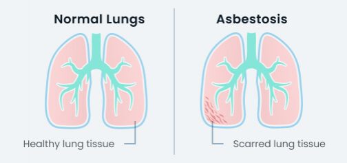 Asbestosis on the lung vs a health lung