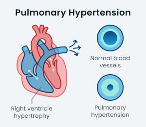 pulmonary hypertension