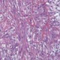 Biphasic mesothelioma cell