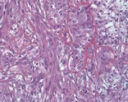 Biphasic mesothelioma cell