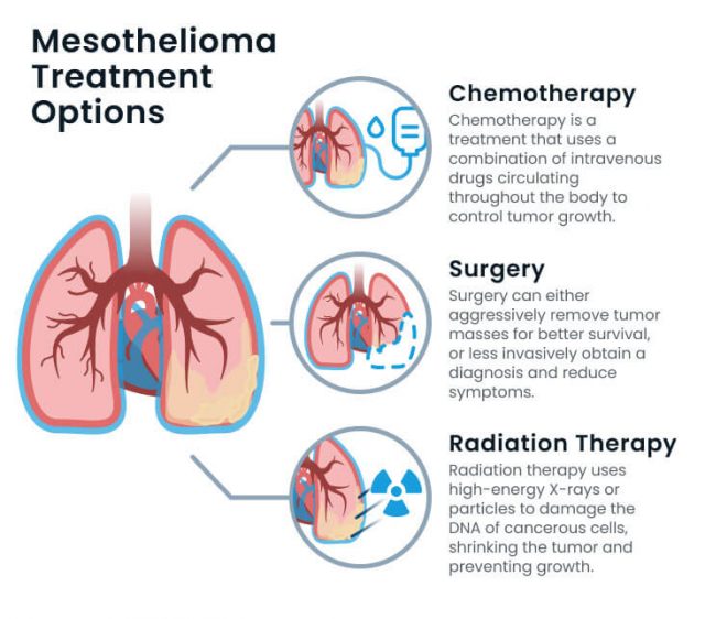 Mesothelioma treatment options