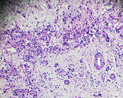 Epithelioid mesothelioma cells