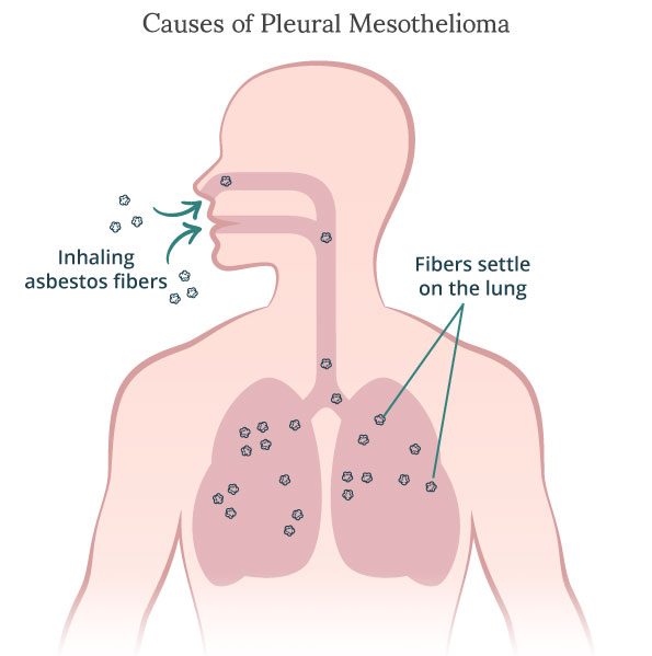 Mesothelioma causes