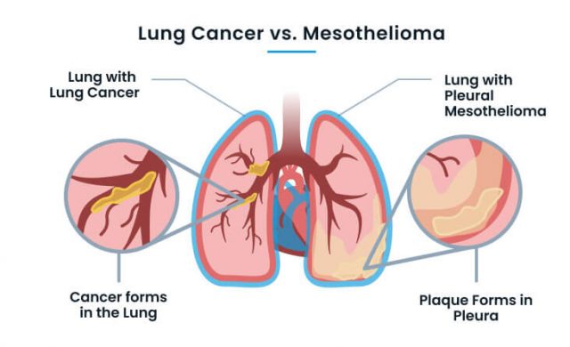 Lung cancer vs mesothelioma