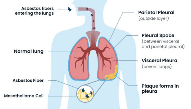 Mesothelioma development diagram