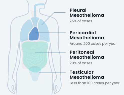 types of mesothelioma by cases