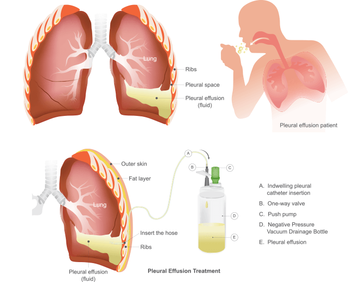 mesothelioma lawsuit reviews