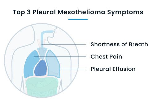 Top 3 pleural mesothelioma symptoms