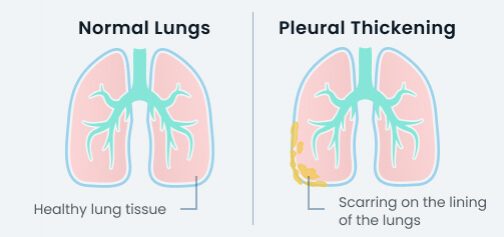 Pleural thickening on the lung vs a healthy lung