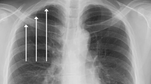 Pleural thickening on an x-ray image