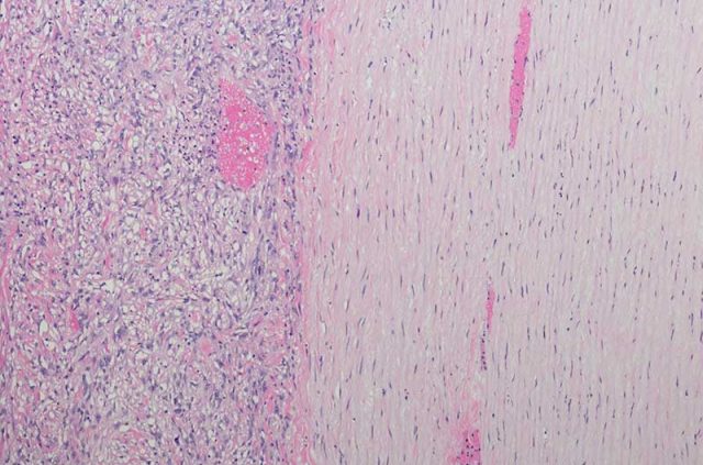 Sarcomatoid mesothelioma cells