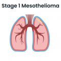 Stage 1 Mesothelioma Lungs