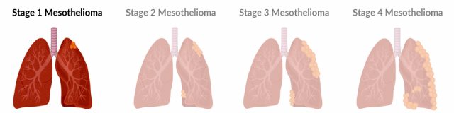 Stage 1 mesothelioma tumor growth