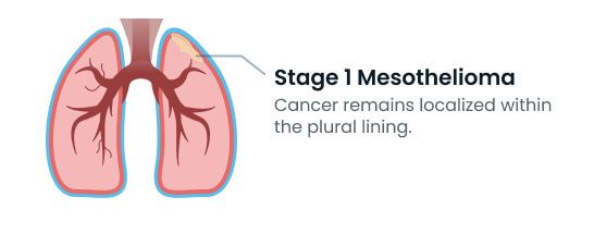 Stage 1 mesothelioma