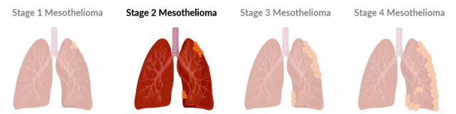 Stage 2 mesothelioma progression