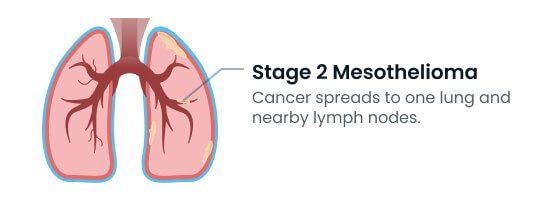 Stage 2 mesothelioma