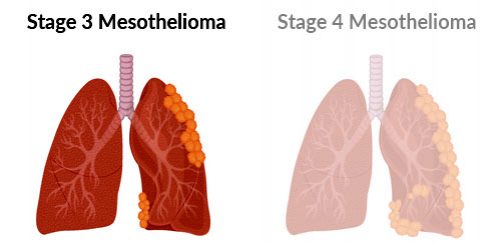 Stage 3 mesothelioma progression