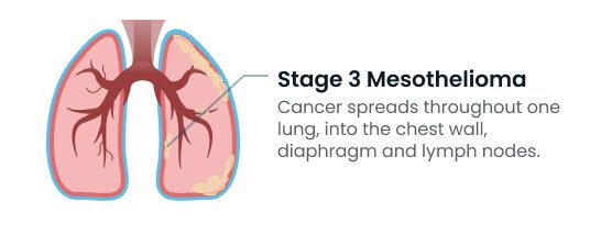 Stage 3 mesothelioma