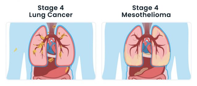 Stage 4 lung cancer vs stage 4 mesothelioma