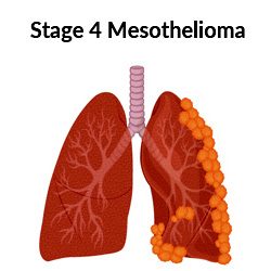 Stage 4 mesothelioma tumors on lung