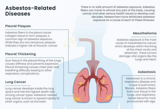 Asbestos related diseases infographic showing pleural plaques, pleural thickening, lung cancer, mesothelioma and asbestosis development.
