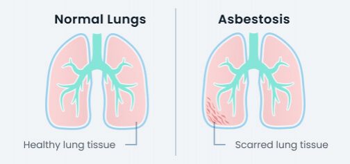 asbestosis vs normal lungs