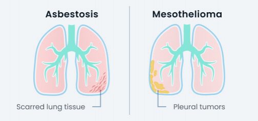 asbestosis vs mesothelioma