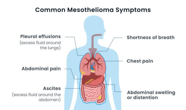 Common mesothelioma symptoms