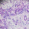 Epithelioid mesothelioma cells