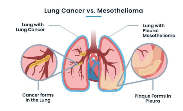 legal definition of mesothelioma