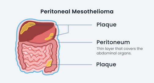 peritoneal-mesothelioma-causes-symptoms-and-treatment-options