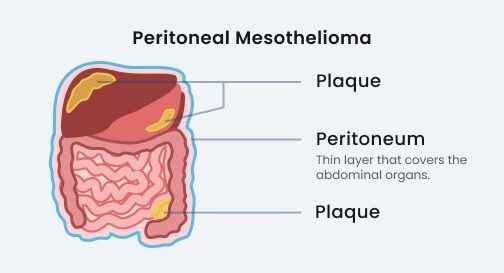 xperitoneal mesothelioma 504x0 c default.jpg.pagespeed.ic.d9xM ou62i