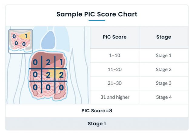 Sample PIC score chart for staging peritoneal mesothelioma