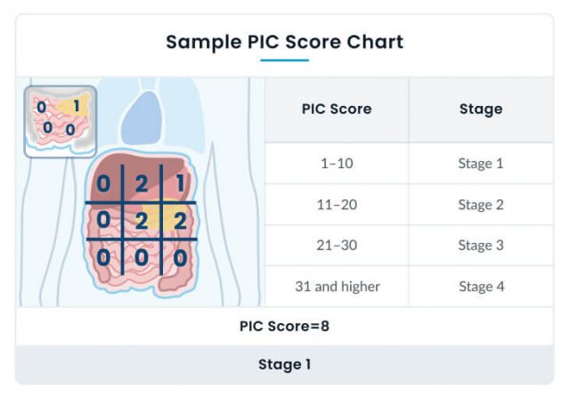 what is the survival rate for medullary thyroid cancer