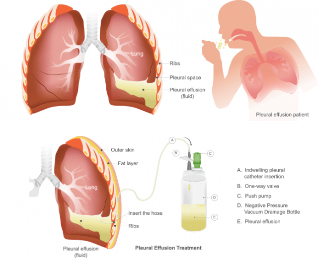Diagram of pleural effusion treatment