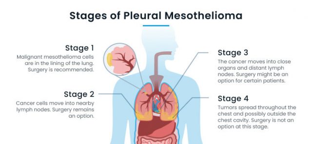 Mesothelioma Stages Understanding The Four Stages
