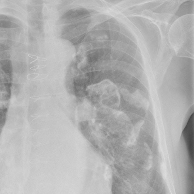 X-ray showing pleural plaques