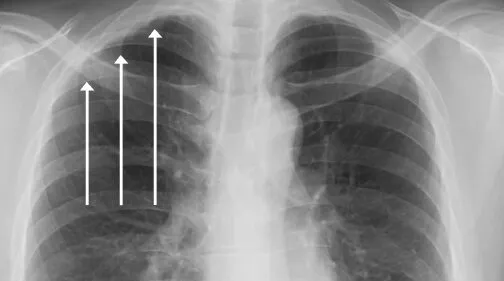 Pleural thickening on an x-ray image
