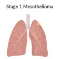 Stage 1 Mesothelioma Lungs