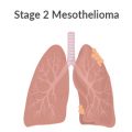 Stage 2 Mesothelioma