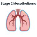 Stage 2 Mesothelioma