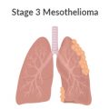 Stage 3 Mesothelioma Lung