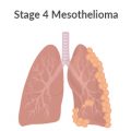 Stage 4 Mesothelioma Lung