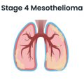 Stage 4 Mesothelioma Lung