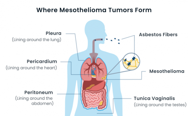 Malignant mesothelioma developing in lungs, abdomen and heart
